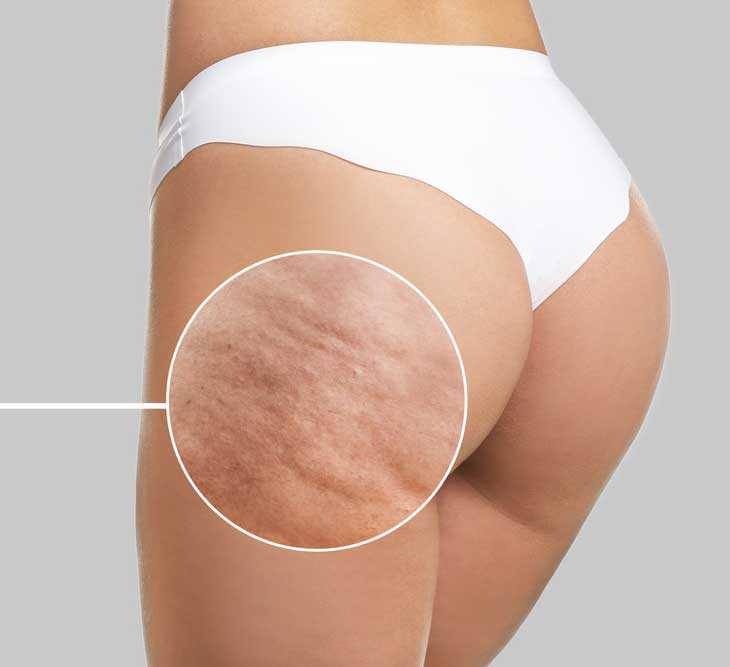 Lipotherapy Cellulite Removal - Healthwatchers360